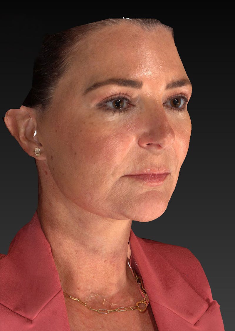 Lower Face & Neck Lift Before & After Gallery - Patient 423170 - Image 4