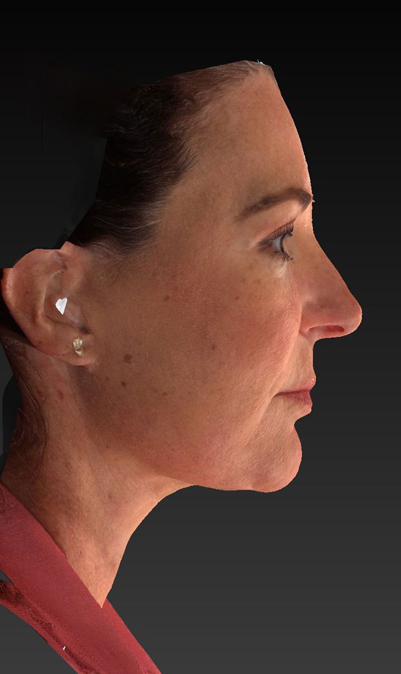 Lower Face & Neck Lift Before & After Gallery - Patient 423170 - Image 6