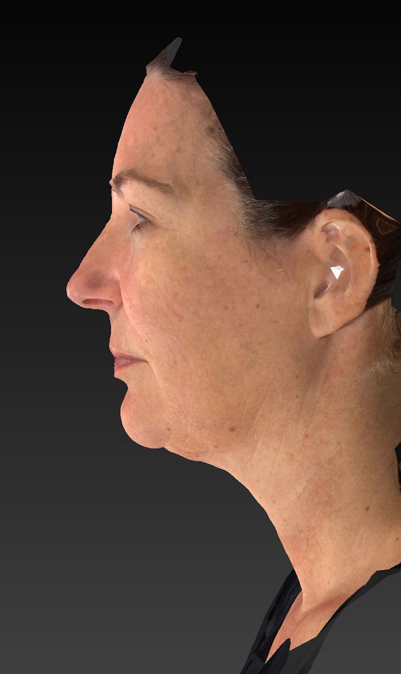 Lower Face & Neck Lift Before & After Gallery - Patient 423170 - Image 7