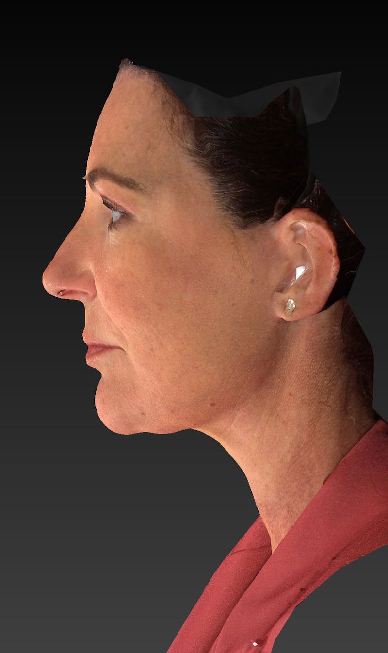 Lower Face & Neck Lift Before & After Gallery - Patient 423170 - Image 8