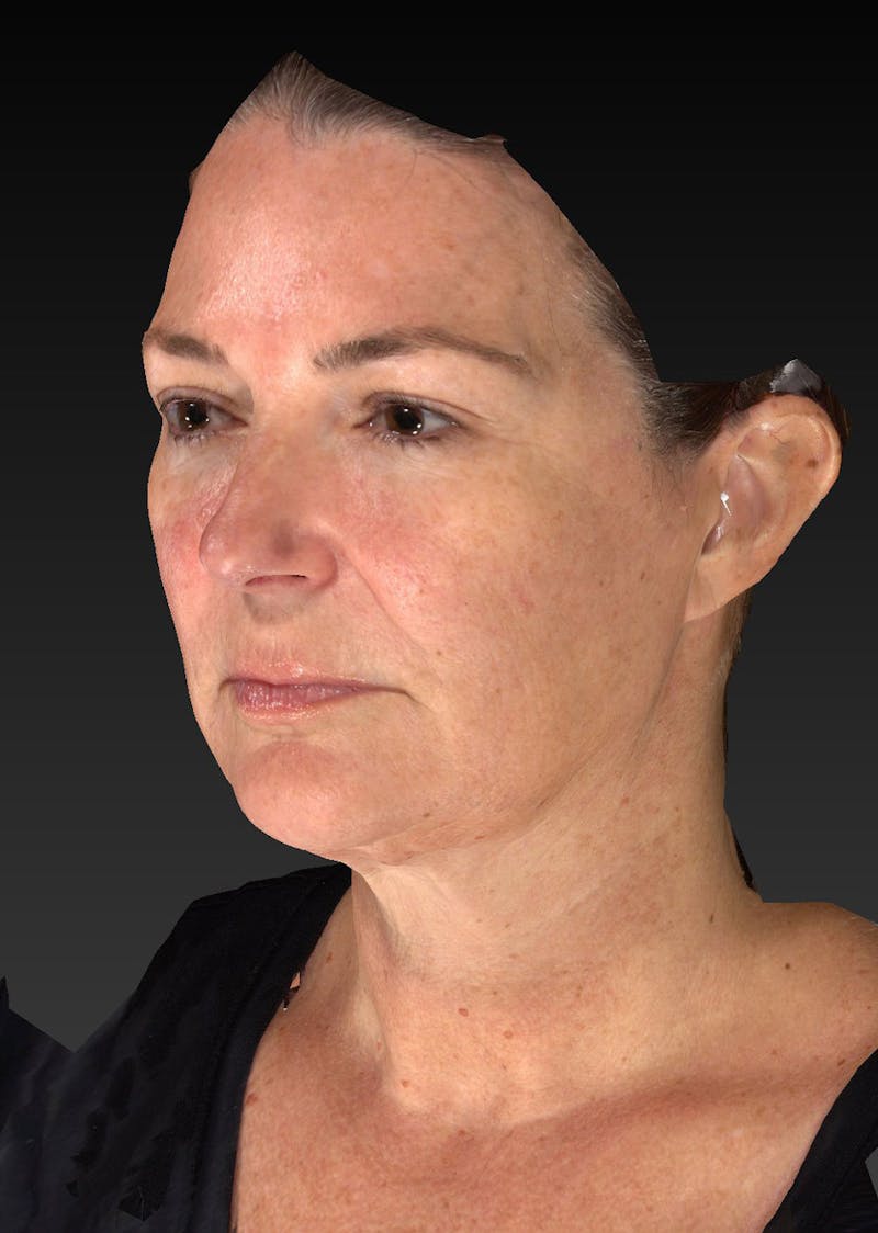 Lower Face & Neck Lift Before & After Gallery - Patient 423170 - Image 9