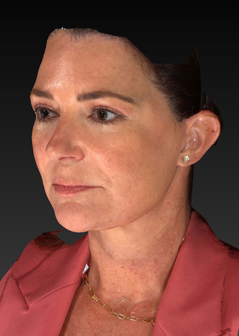 Lower Face & Neck Lift Before & After Gallery - Patient 423170 - Image 10