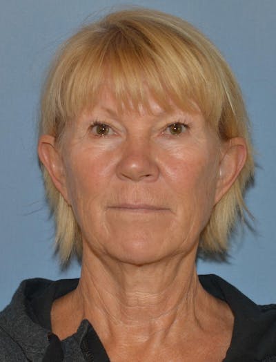 Lower Face & Neck Lift Before & After Gallery - Patient 256519 - Image 1