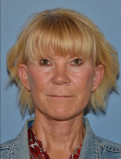 Lower Face & Neck Lift Before & After Gallery - Patient 256519 - Image 2