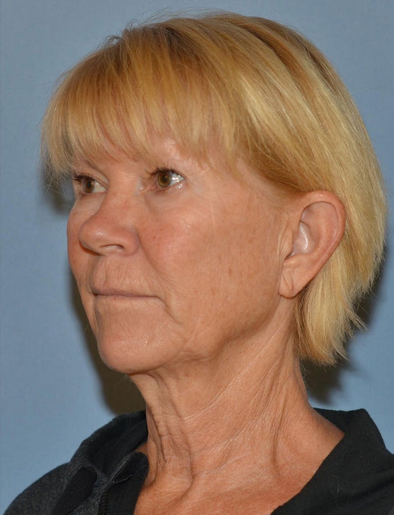 Lower Face & Neck Lift Before & After Gallery - Patient 256519 - Image 3