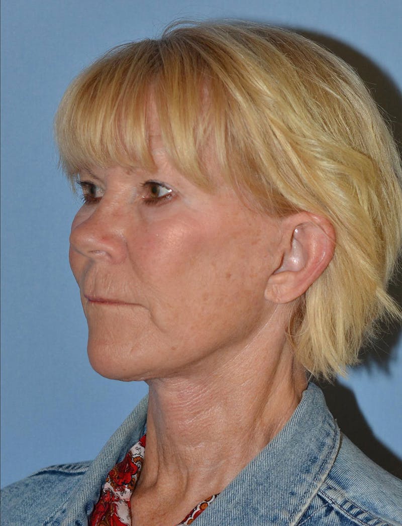 Lower Face & Neck Lift Before & After Gallery - Patient 256519 - Image 4