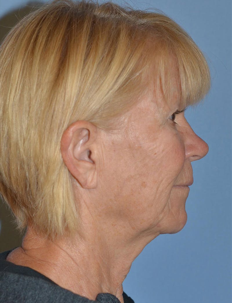 Lower Face & Neck Lift Before & After Gallery - Patient 256519 - Image 5