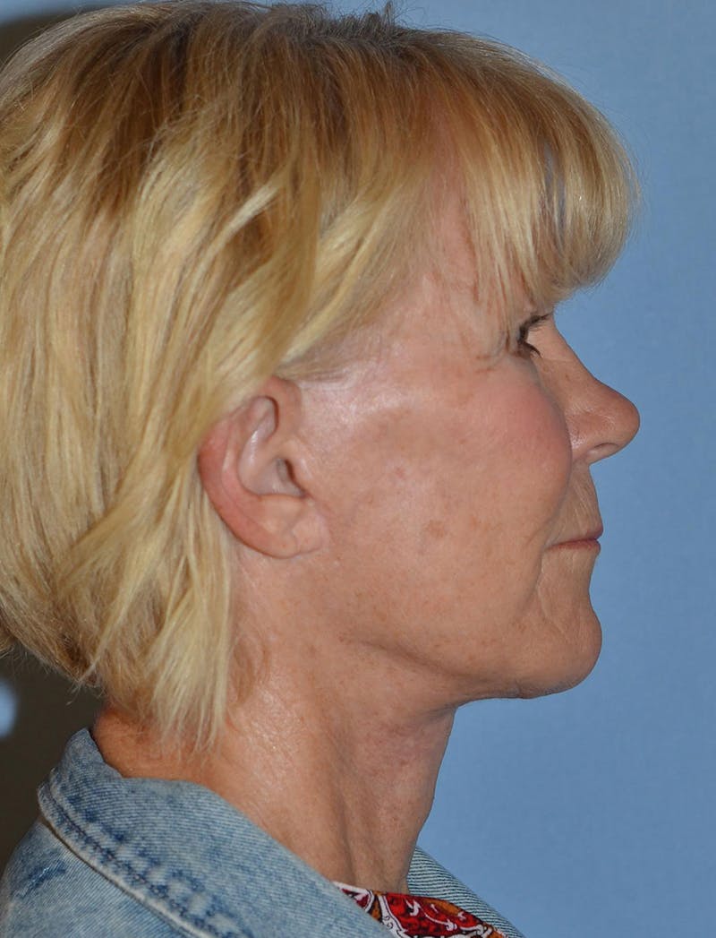Lower Face & Neck Lift Before & After Gallery - Patient 256519 - Image 6