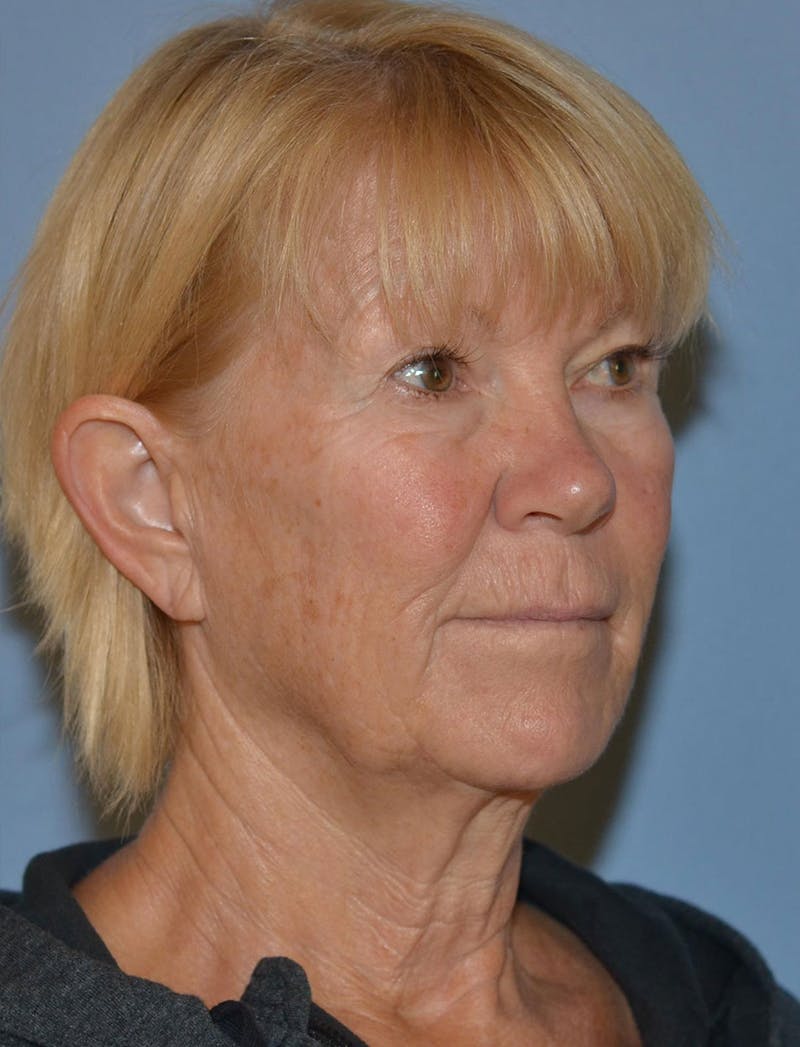 Lower Face & Neck Lift Before & After Gallery - Patient 256519 - Image 7