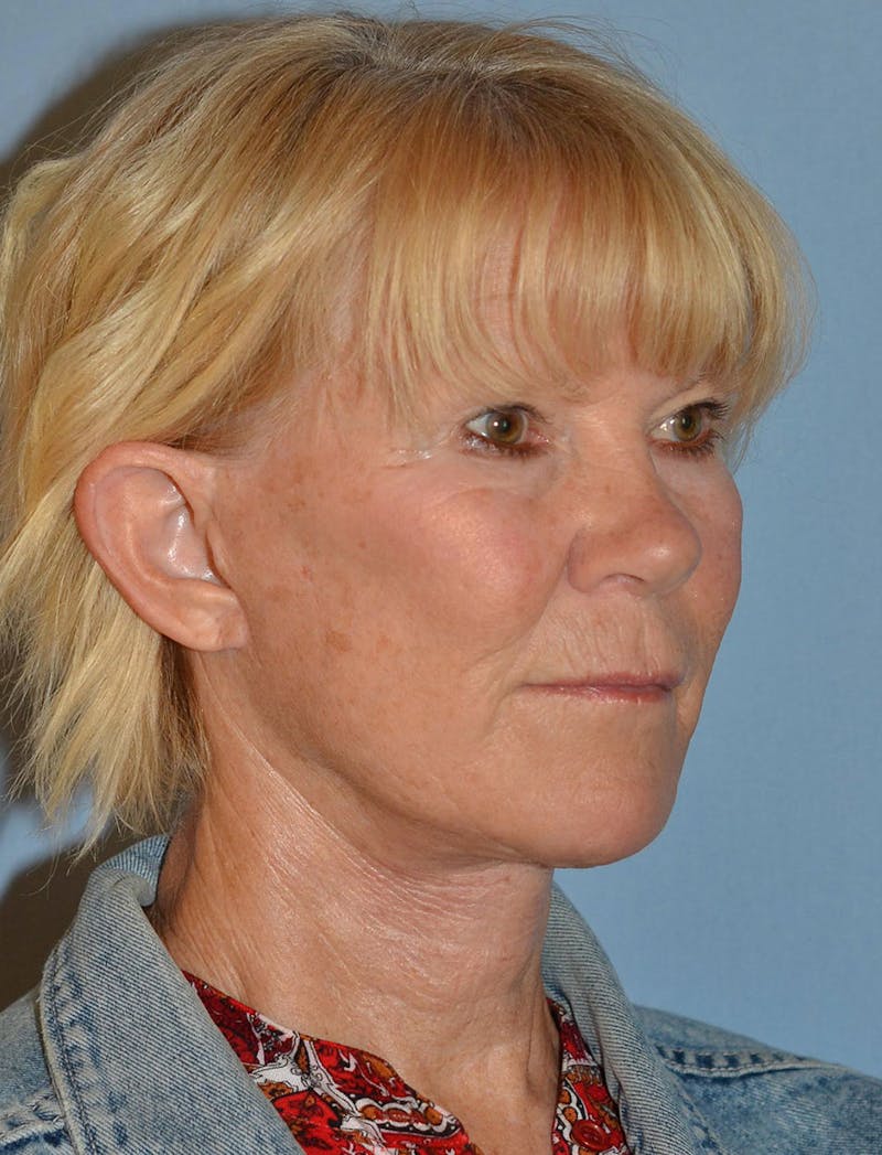 Lower Face & Neck Lift Before & After Gallery - Patient 256519 - Image 8