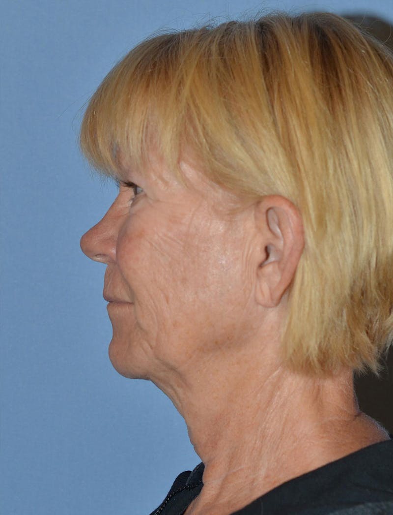 Lower Face & Neck Lift Before & After Gallery - Patient 256519 - Image 9