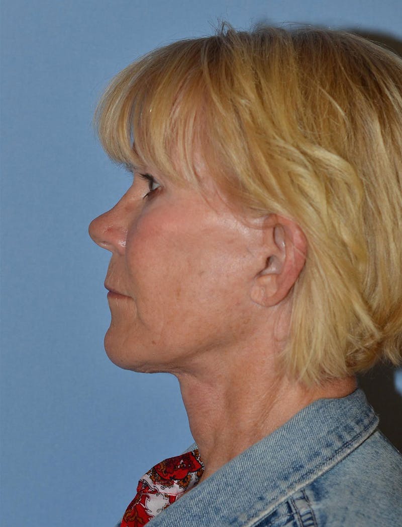 Lower Face & Neck Lift Before & After Gallery - Patient 256519 - Image 10