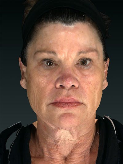 Lower Face & Neck Lift Before & After Gallery - Patient 121657 - Image 1