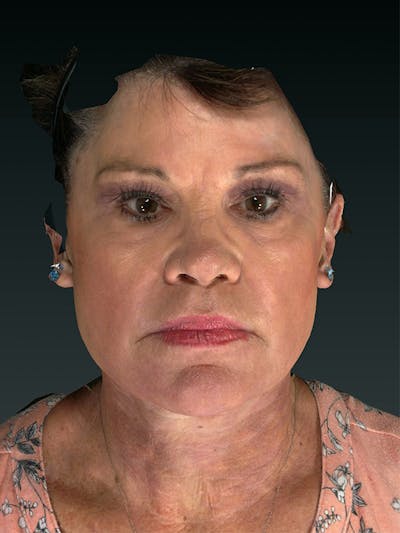 Lower Face & Neck Lift Before & After Gallery - Patient 121657 - Image 2
