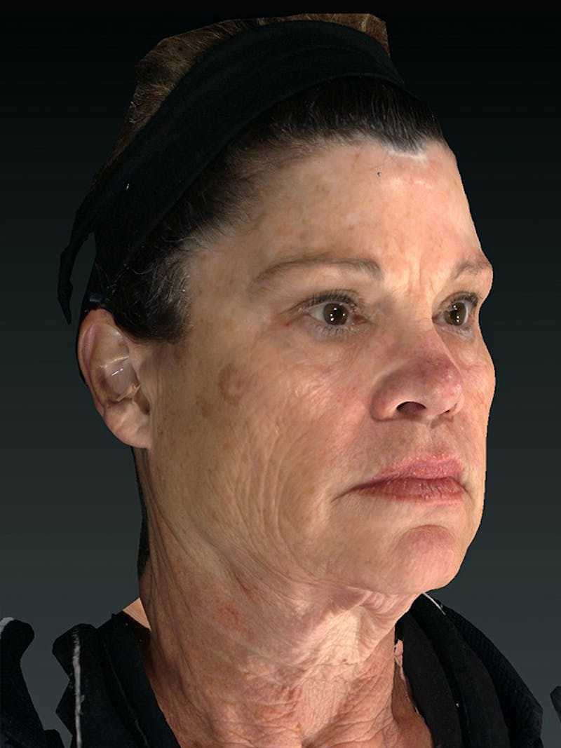 Lower Face & Neck Lift Before & After Gallery - Patient 121657 - Image 3