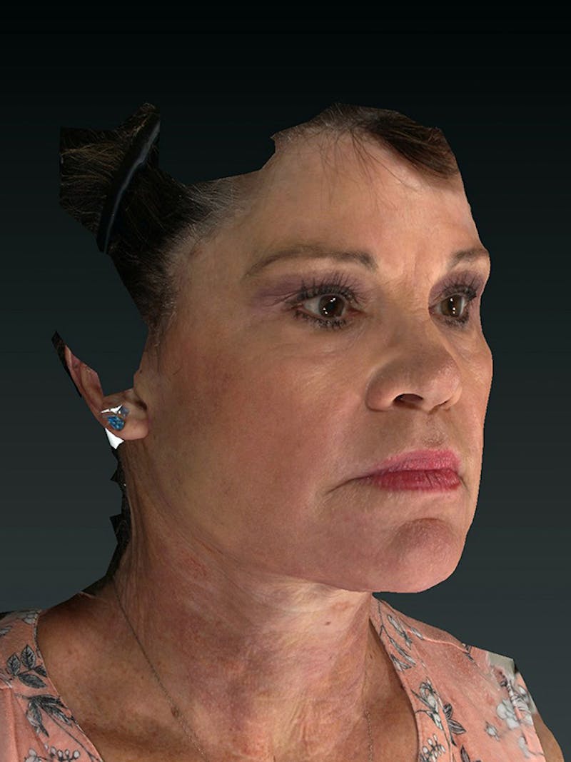 Lower Face & Neck Lift Before & After Gallery - Patient 121657 - Image 4