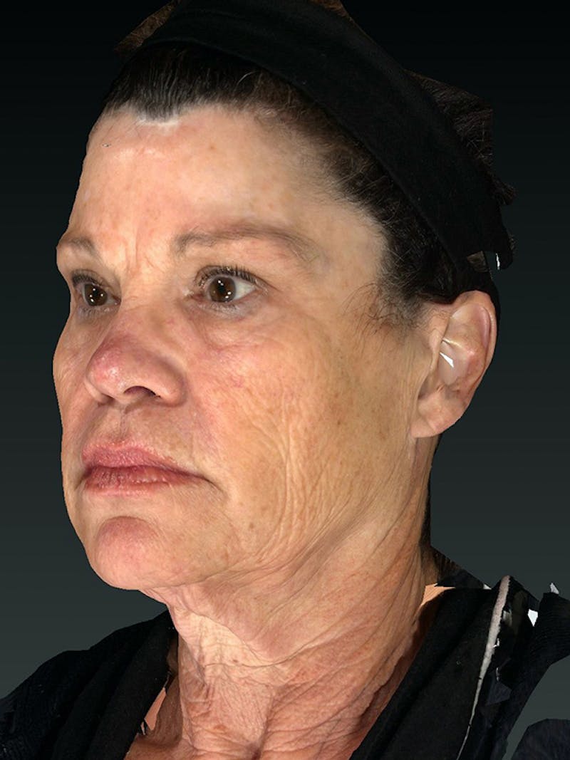 Lower Face & Neck Lift Before & After Gallery - Patient 121657 - Image 5