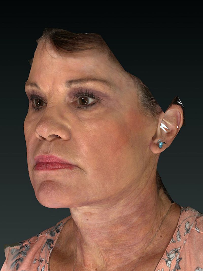Lower Face & Neck Lift Before & After Gallery - Patient 121657 - Image 6