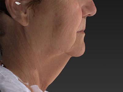 Lower Face & Neck Lift Before & After Gallery - Patient 234687 - Image 1