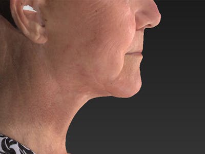 Lower Face & Neck Lift Before & After Gallery - Patient 234687 - Image 2