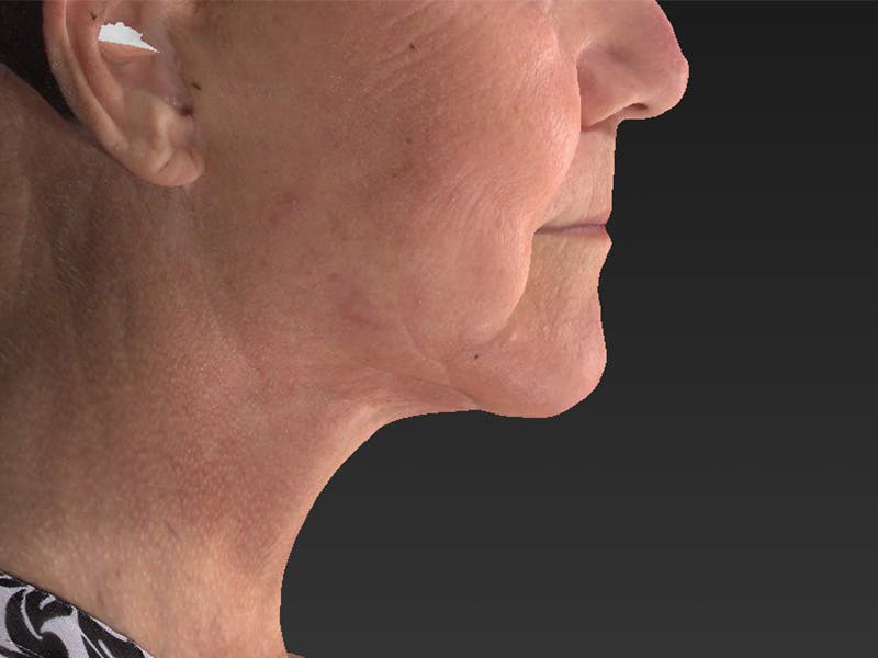 Lower Face & Neck Lift Before & After Gallery - Patient 234687 - Image 2
