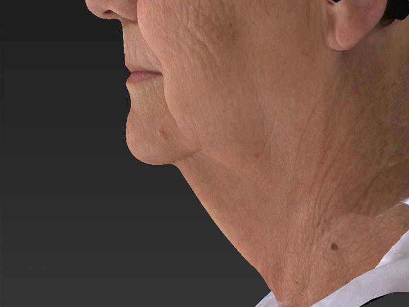 Lower Face & Neck Lift Before & After Gallery - Patient 234687 - Image 3