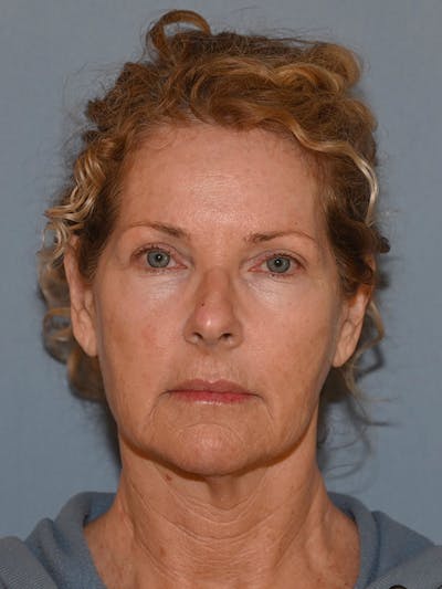 Lower Face & Neck Lift Before & After Gallery - Patient 963129 - Image 1