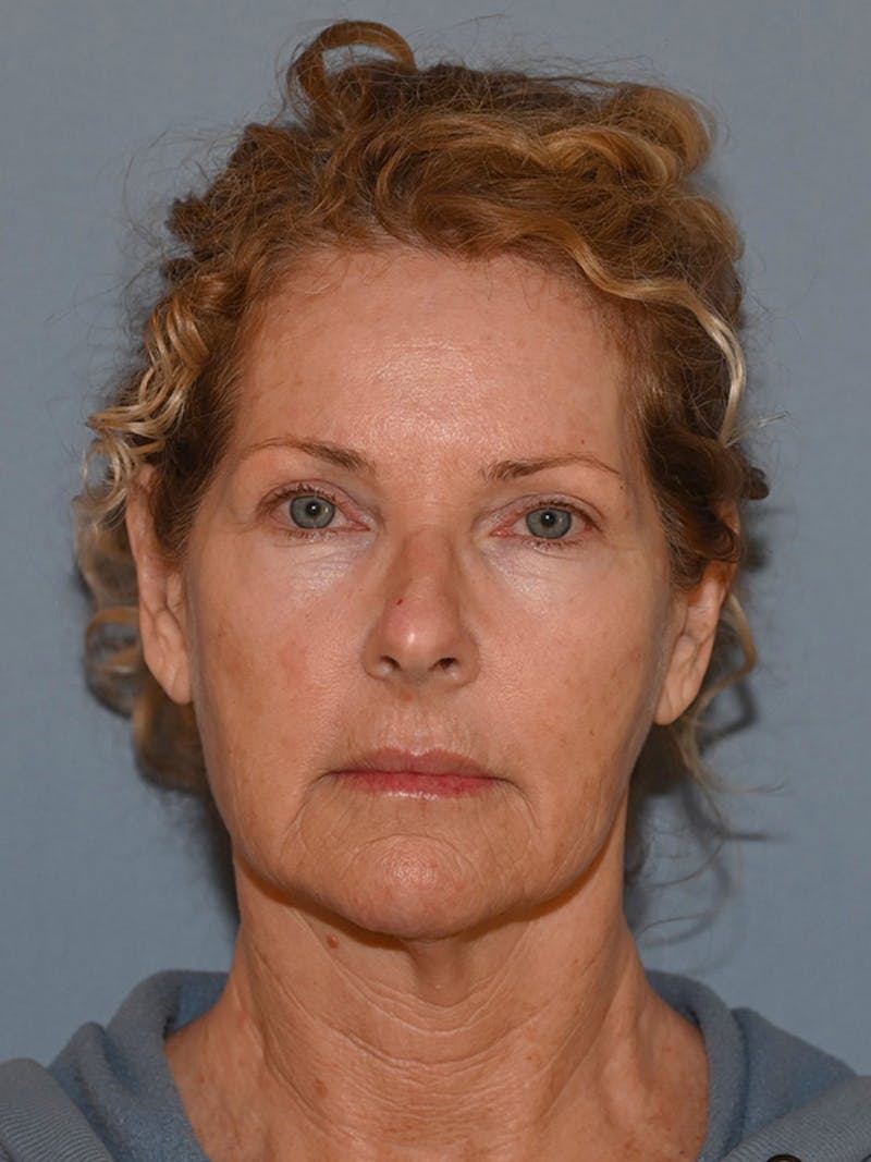 Lower Face & Neck Lift Before & After Gallery - Patient 963129 - Image 1