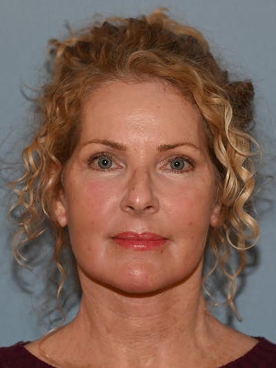 Lower Face & Neck Lift Before & After Gallery - Patient 963129 - Image 2