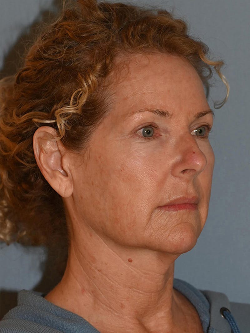 Lower Face & Neck Lift Before & After Gallery - Patient 963129 - Image 3