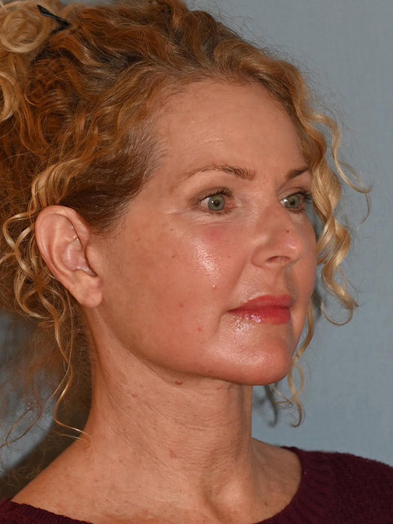 Lower Face & Neck Lift Before & After Gallery - Patient 963129 - Image 4