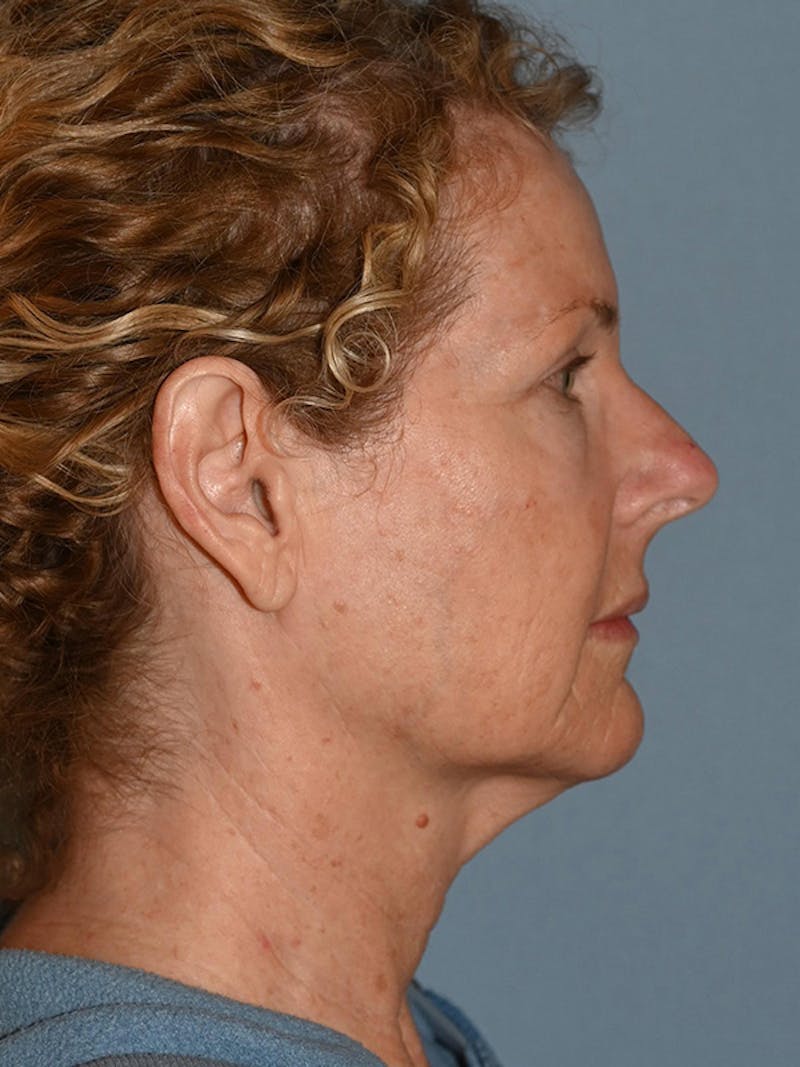 Lower Face & Neck Lift Before & After Gallery - Patient 963129 - Image 5