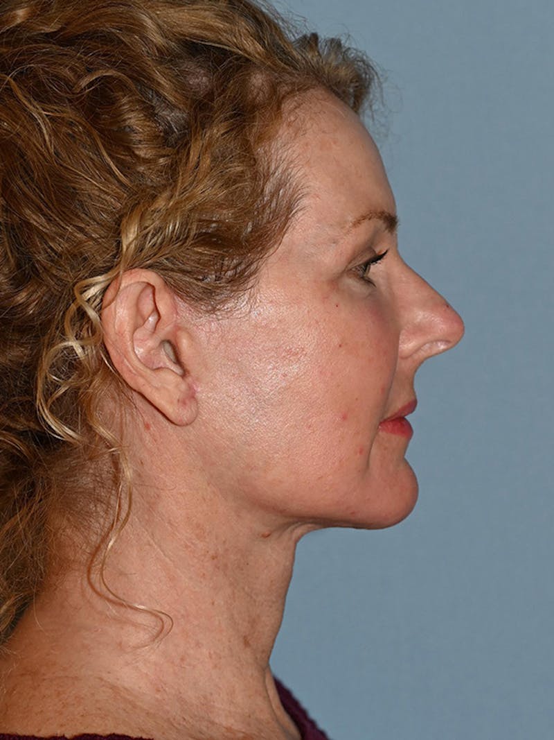 Lower Face & Neck Lift Before & After Gallery - Patient 963129 - Image 6