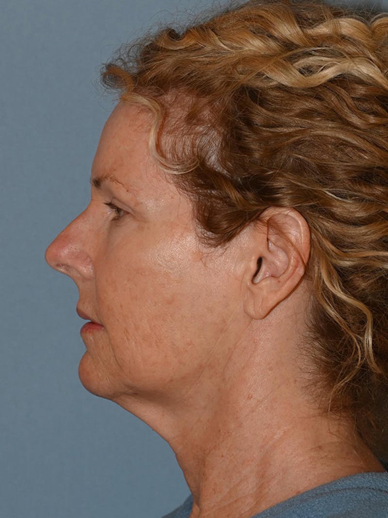 Lower Face & Neck Lift Before & After Gallery - Patient 963129 - Image 7