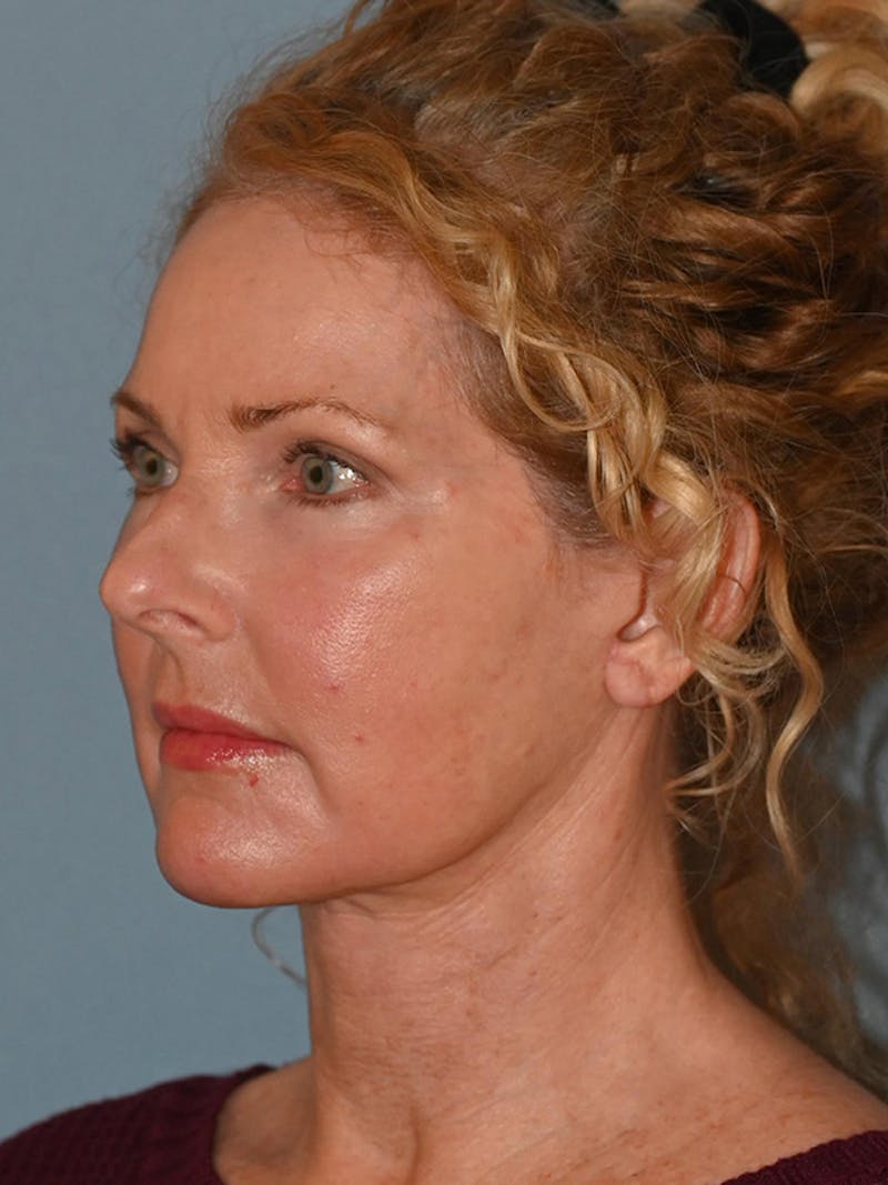 Lower Face & Neck Lift Before & After Gallery - Patient 963129 - Image 10