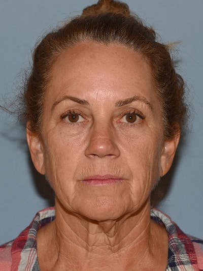 Lower Face & Neck Lift Before & After Gallery - Patient 228004 - Image 1