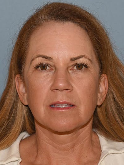 Lower Face & Neck Lift Before & After Gallery - Patient 228004 - Image 2