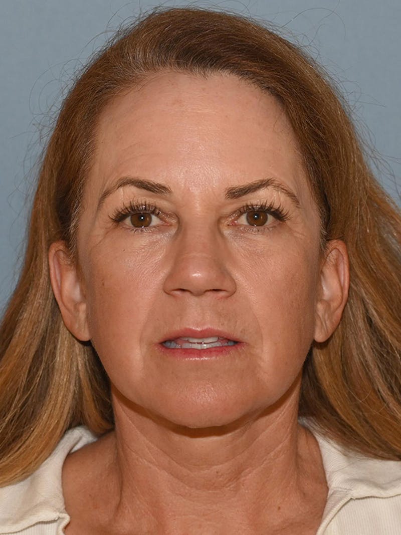 Lower Face & Neck Lift Before & After Gallery - Patient 228004 - Image 2
