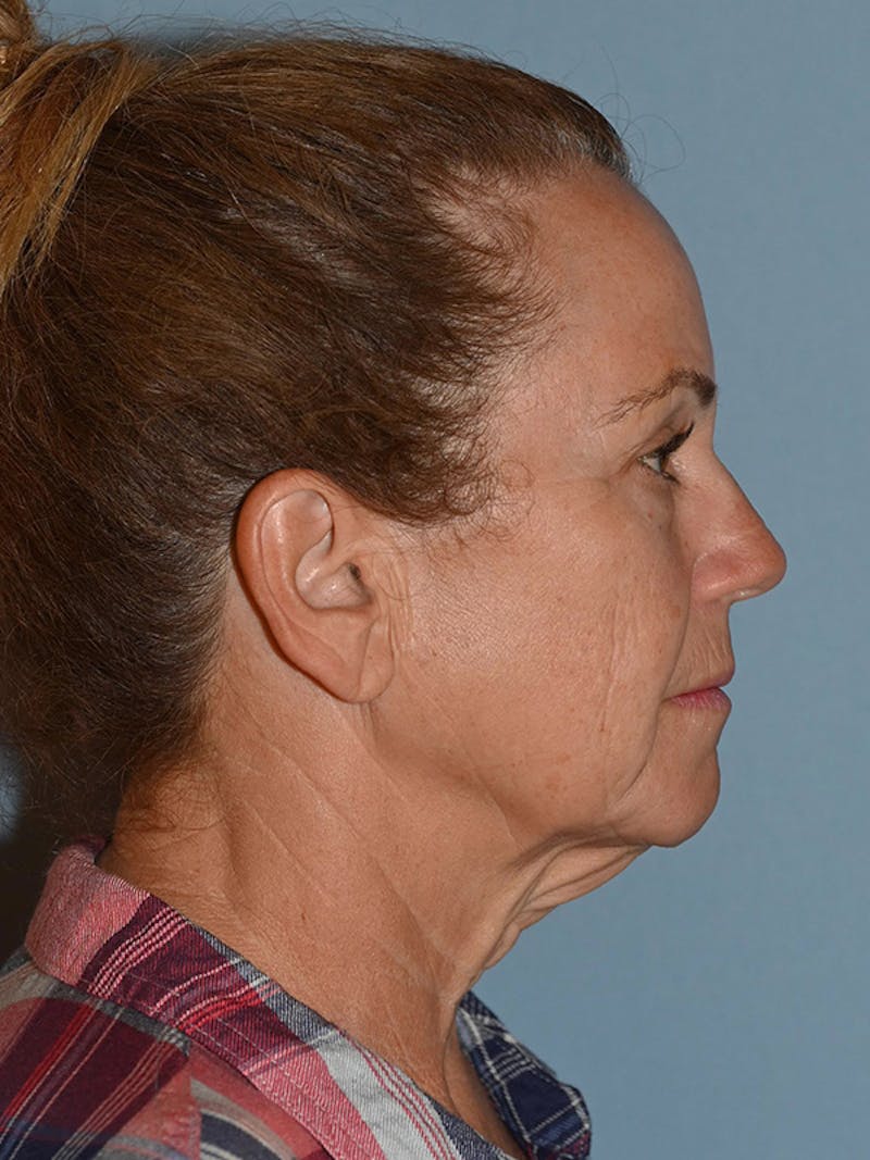 Lower Face & Neck Lift Before & After Gallery - Patient 228004 - Image 3