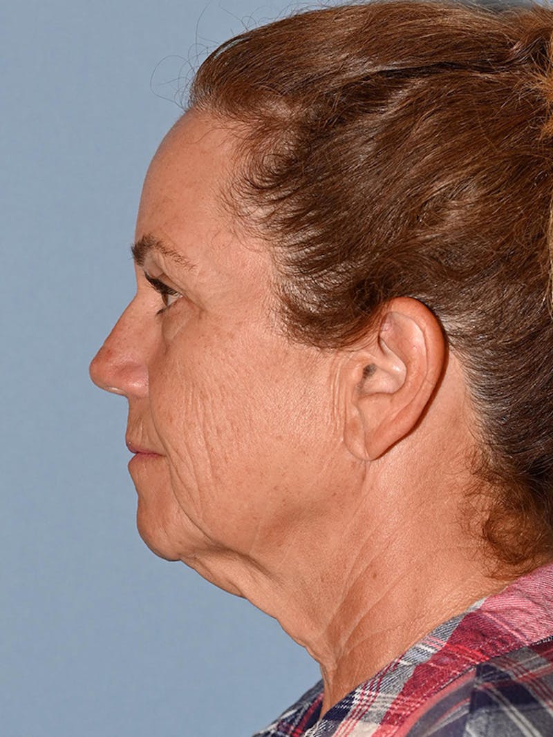 Lower Face & Neck Lift Before & After Gallery - Patient 228004 - Image 5