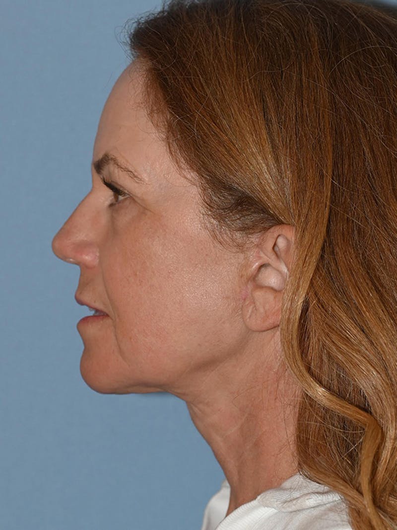 Lower Face & Neck Lift Before & After Gallery - Patient 228004 - Image 6