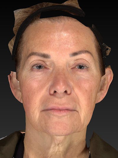Lower Face & Neck Lift Before & After Gallery - Patient 191429 - Image 1