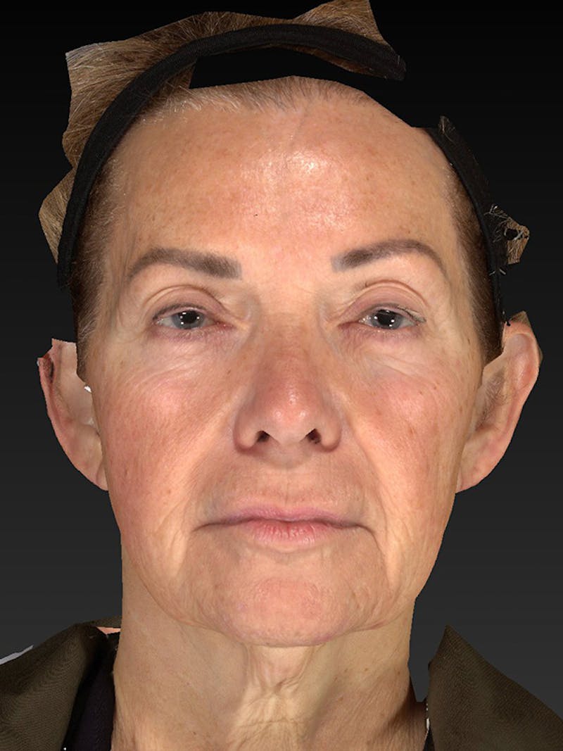 Lower Face & Neck Lift Before & After Gallery - Patient 191429 - Image 1