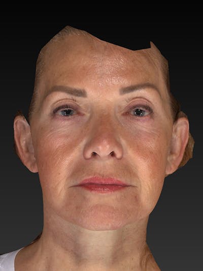 Lower Face & Neck Lift Before & After Gallery - Patient 191429 - Image 2