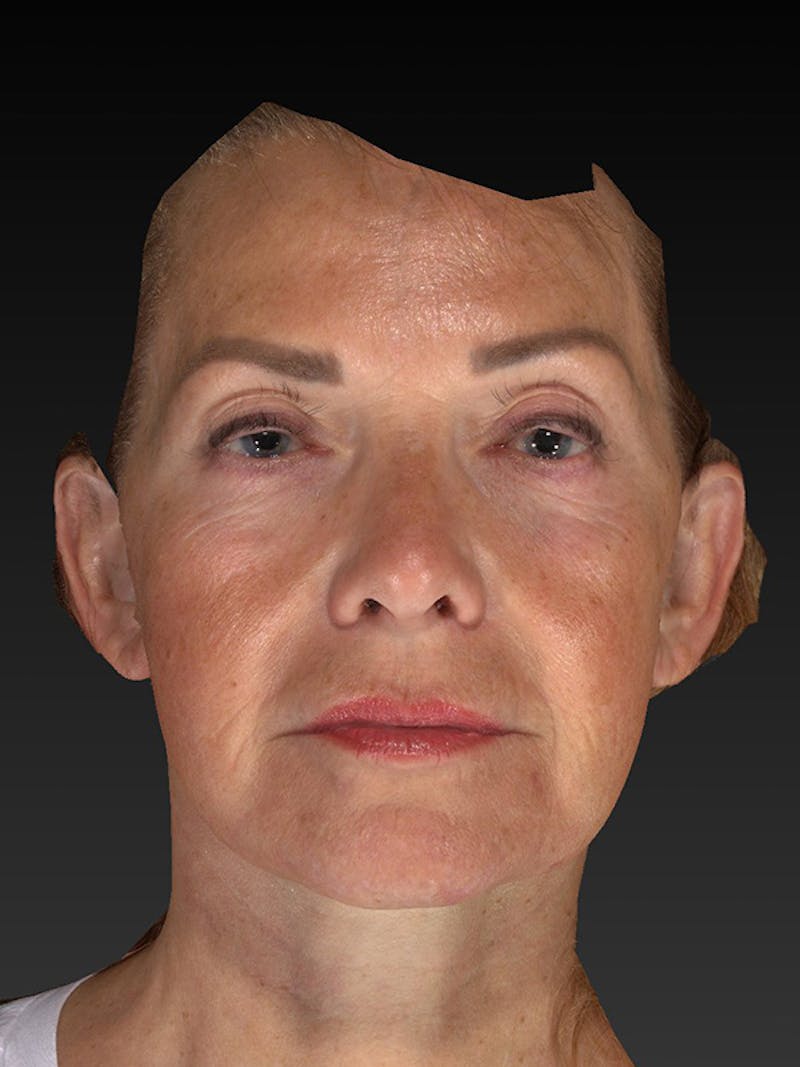 Lower Face & Neck Lift Before & After Gallery - Patient 191429 - Image 2