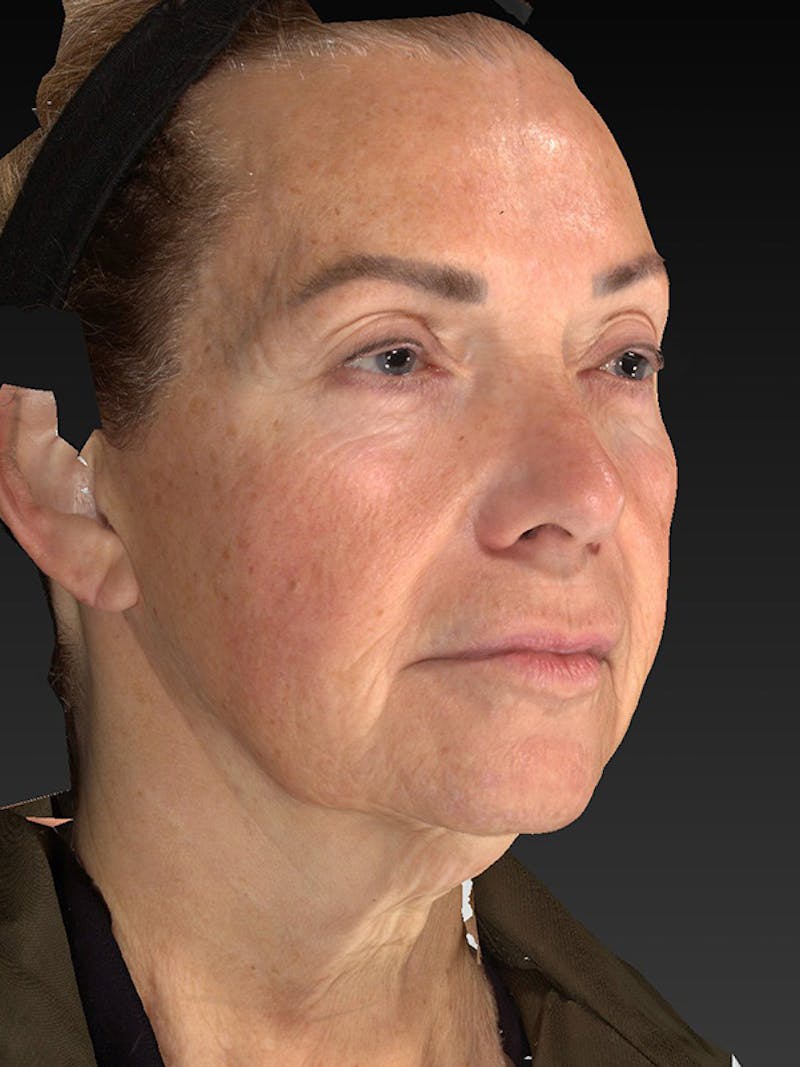 Lower Face & Neck Lift Before & After Gallery - Patient 191429 - Image 3