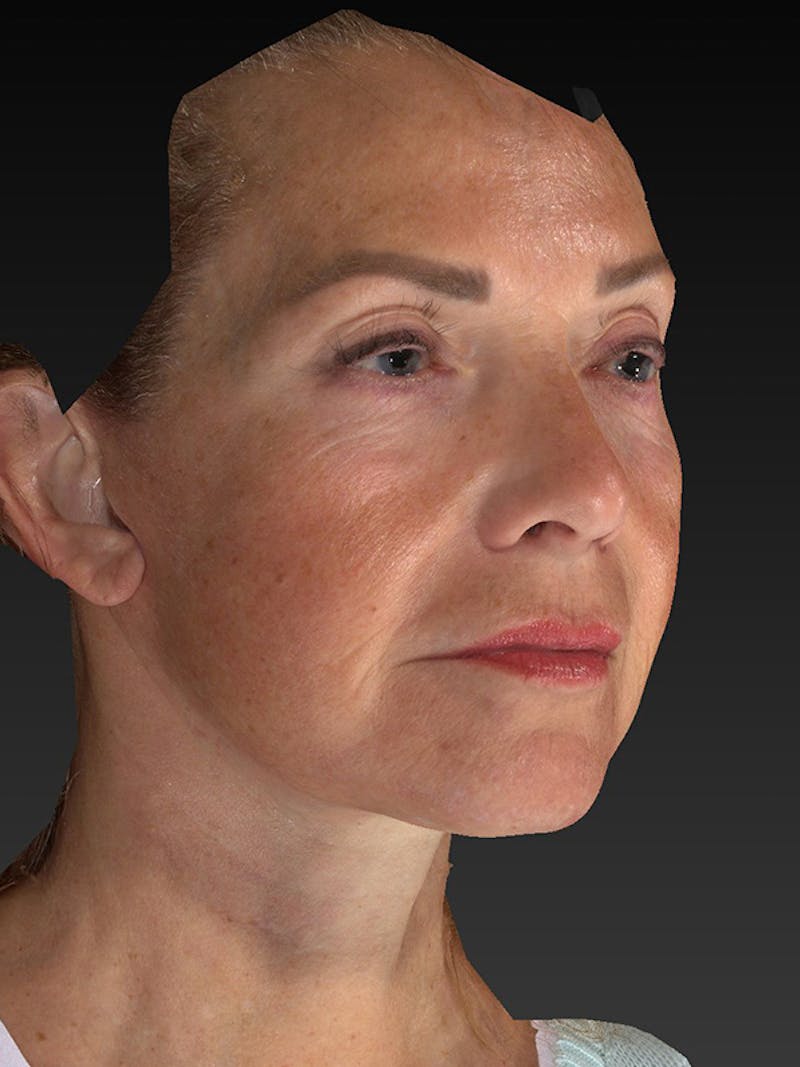 Lower Face & Neck Lift Before & After Gallery - Patient 191429 - Image 4