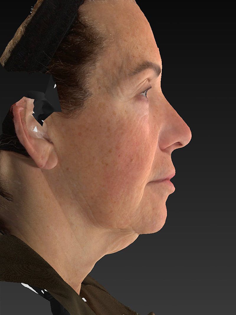 Lower Face & Neck Lift Before & After Gallery - Patient 191429 - Image 5