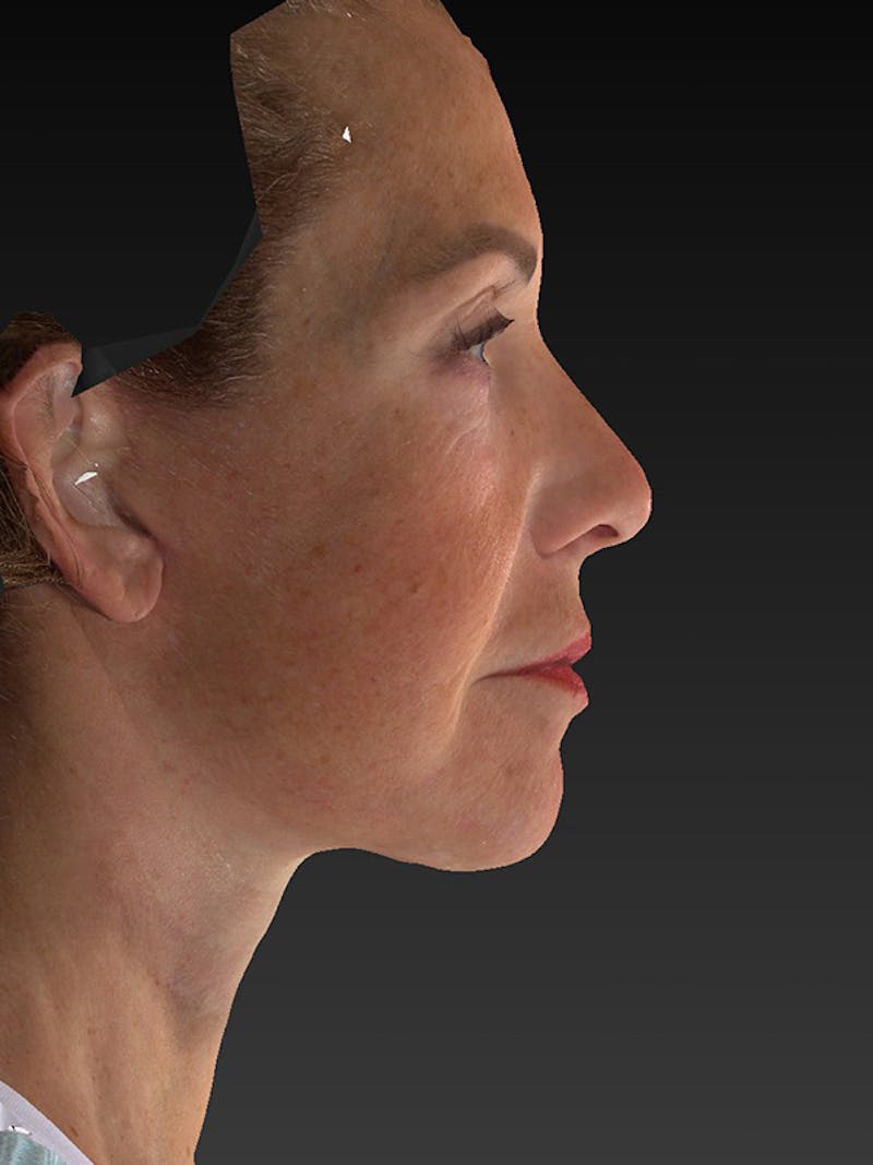 Lower Face & Neck Lift Before & After Gallery - Patient 191429 - Image 6