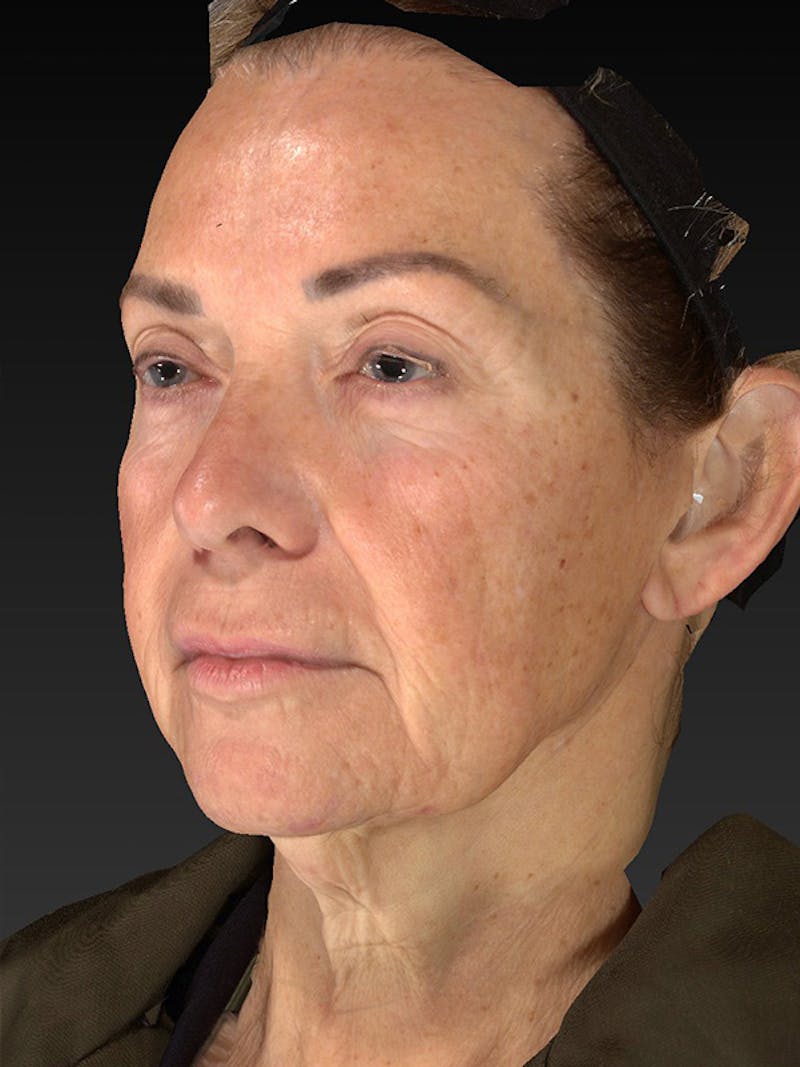 Lower Face & Neck Lift Before & After Gallery - Patient 191429 - Image 7